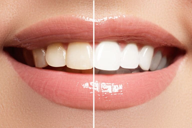 shutterstock_308947793-768x512 Teeth Whitening in Charlotte & Huntersville, NC